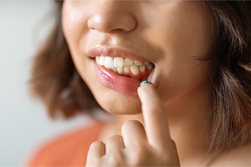 Healthy vs unhealthy gums comparison